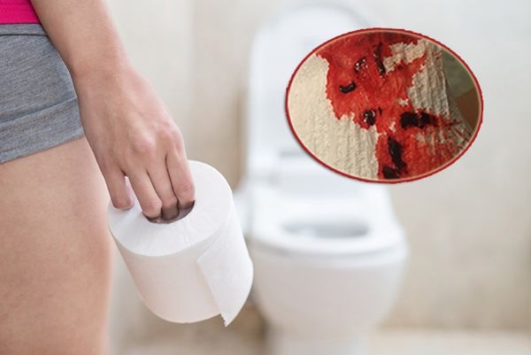 Điều trị đi cầu ra máu tươi - đau rát hậu môn